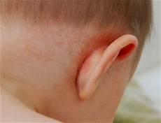 Ear Cradle