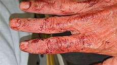 Narrow Staples