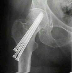 Screw