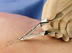 Staple Remover