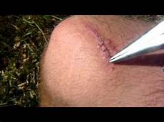 Stapler Without Staples